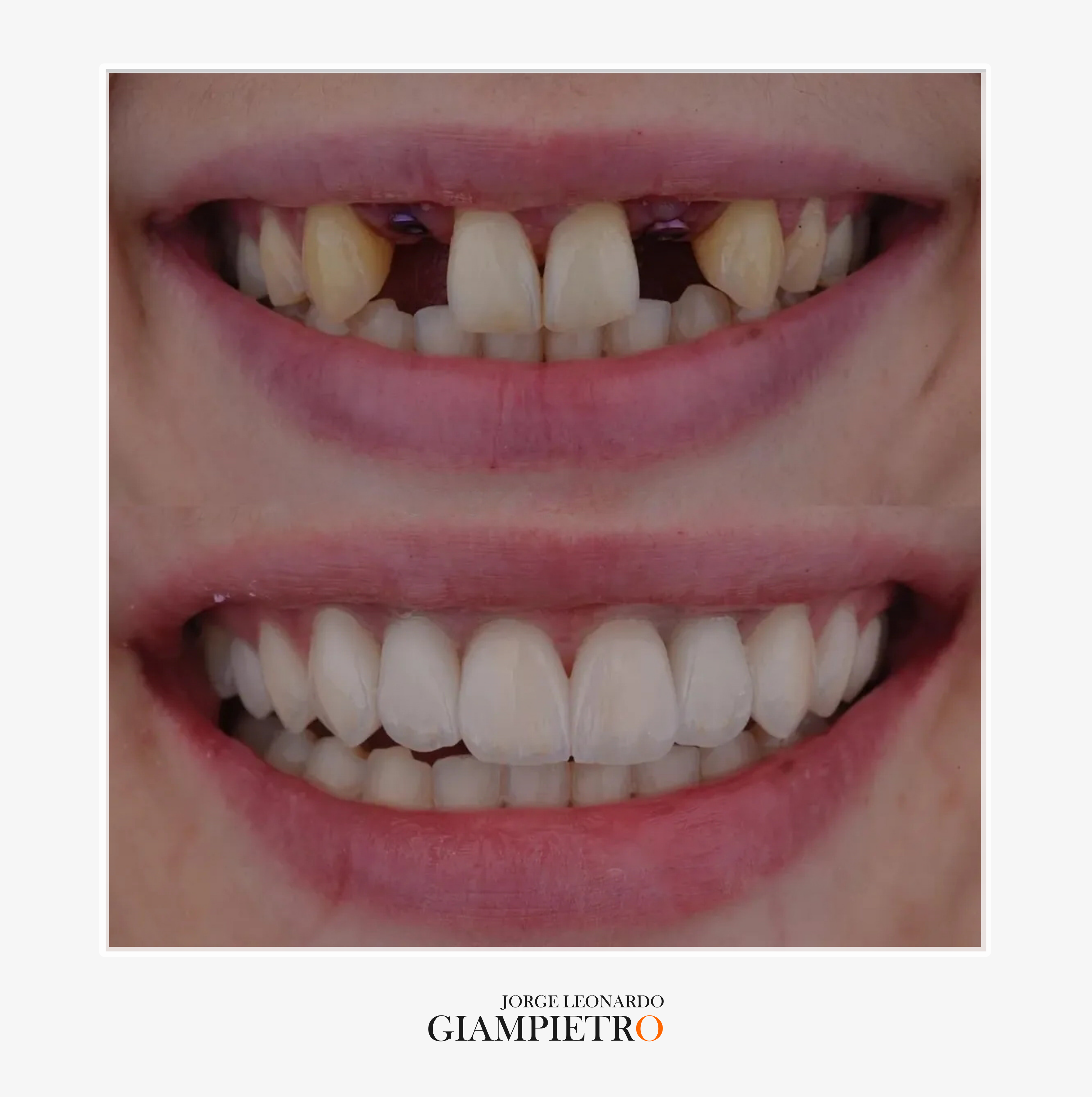 Implantes dentales