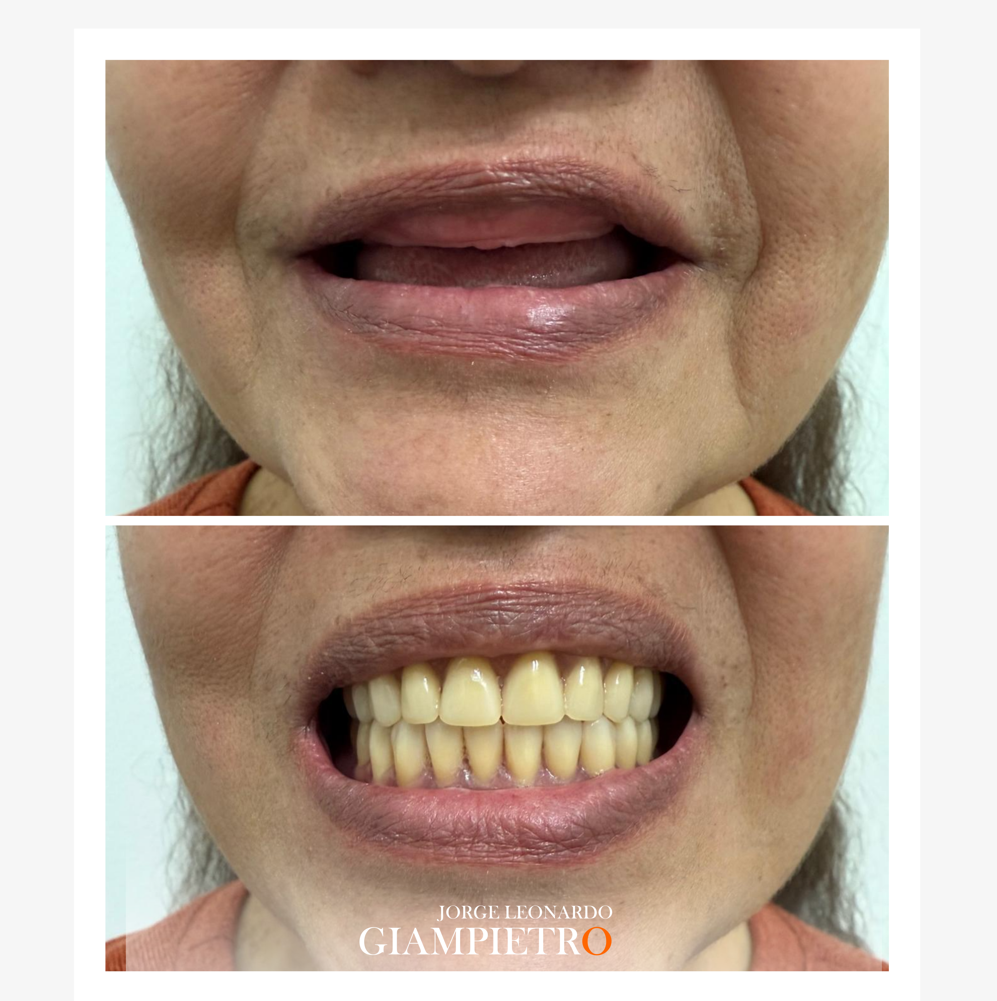 Prótesis dental