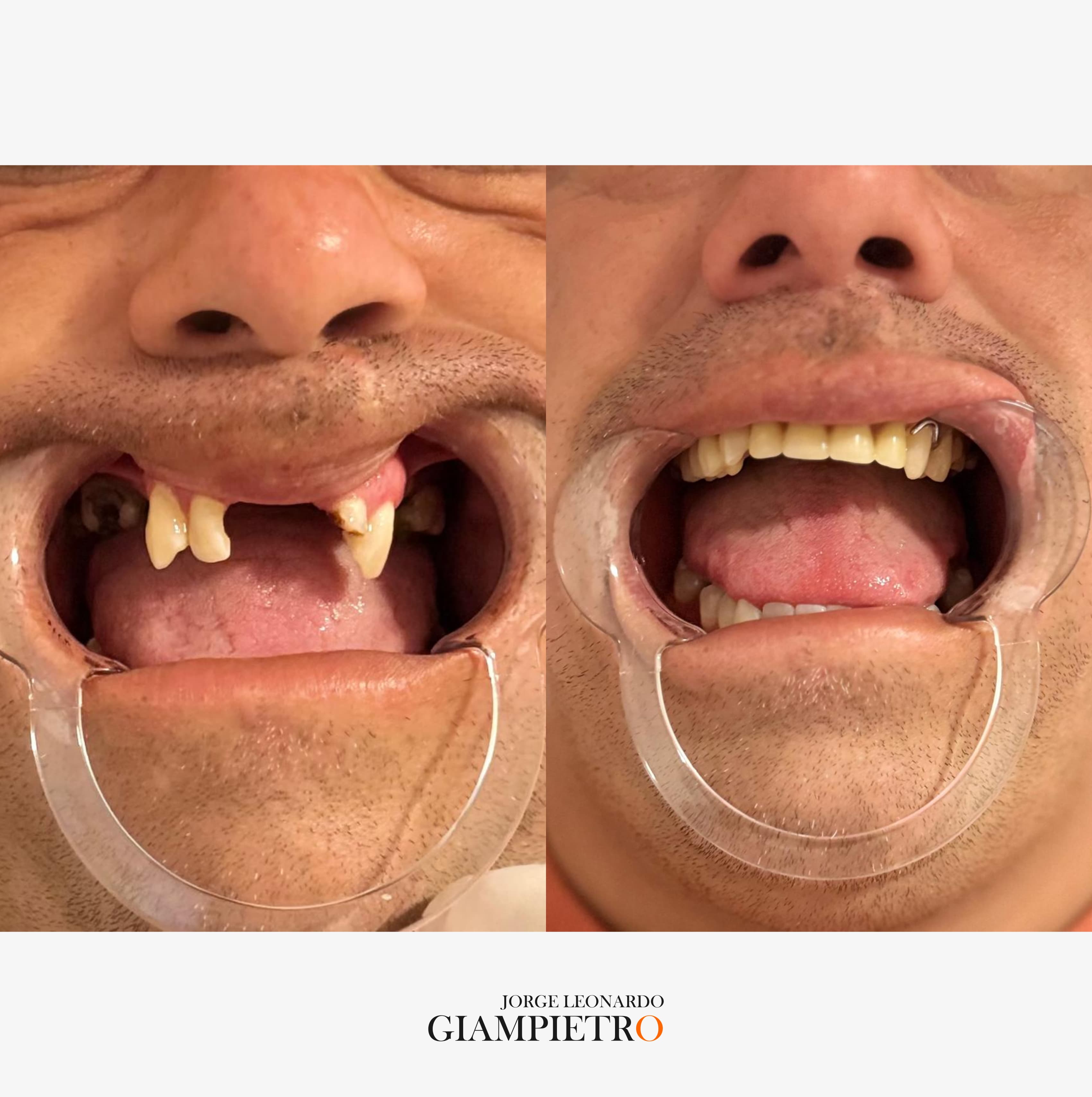 Prótesis dental