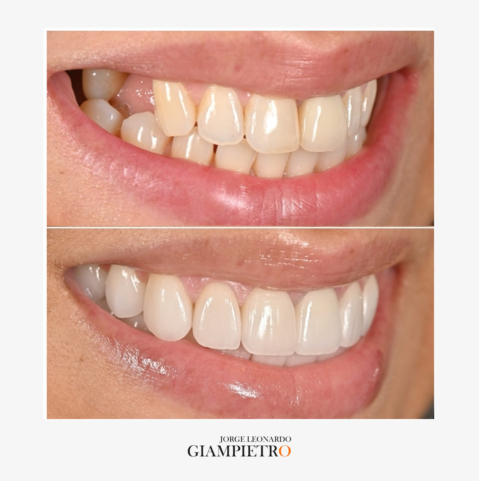 Implantes dentales